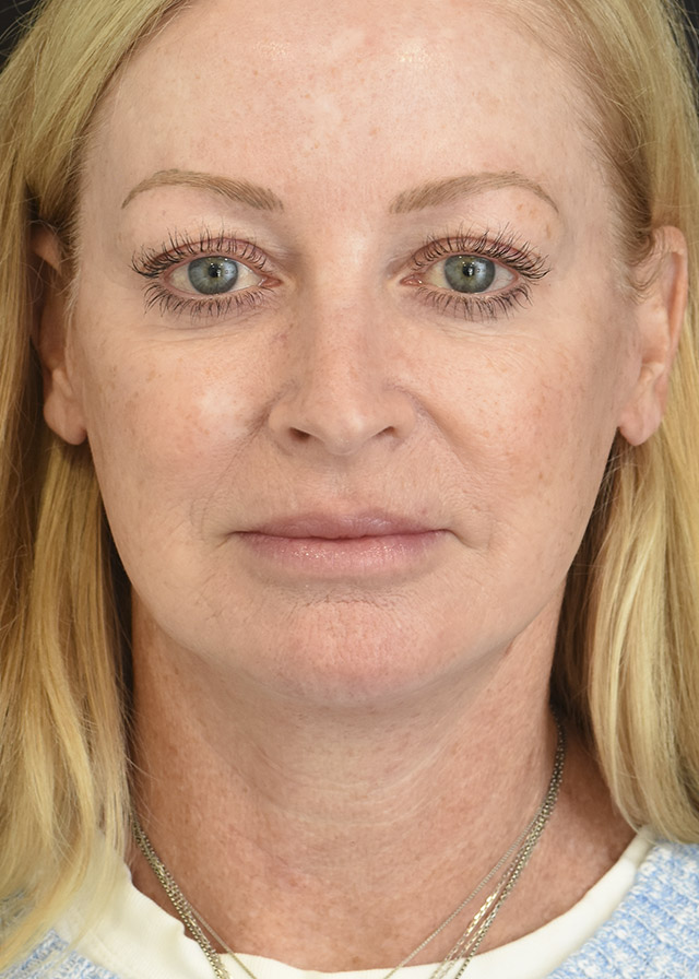 Neck Lift Patient 45 Set 1 After